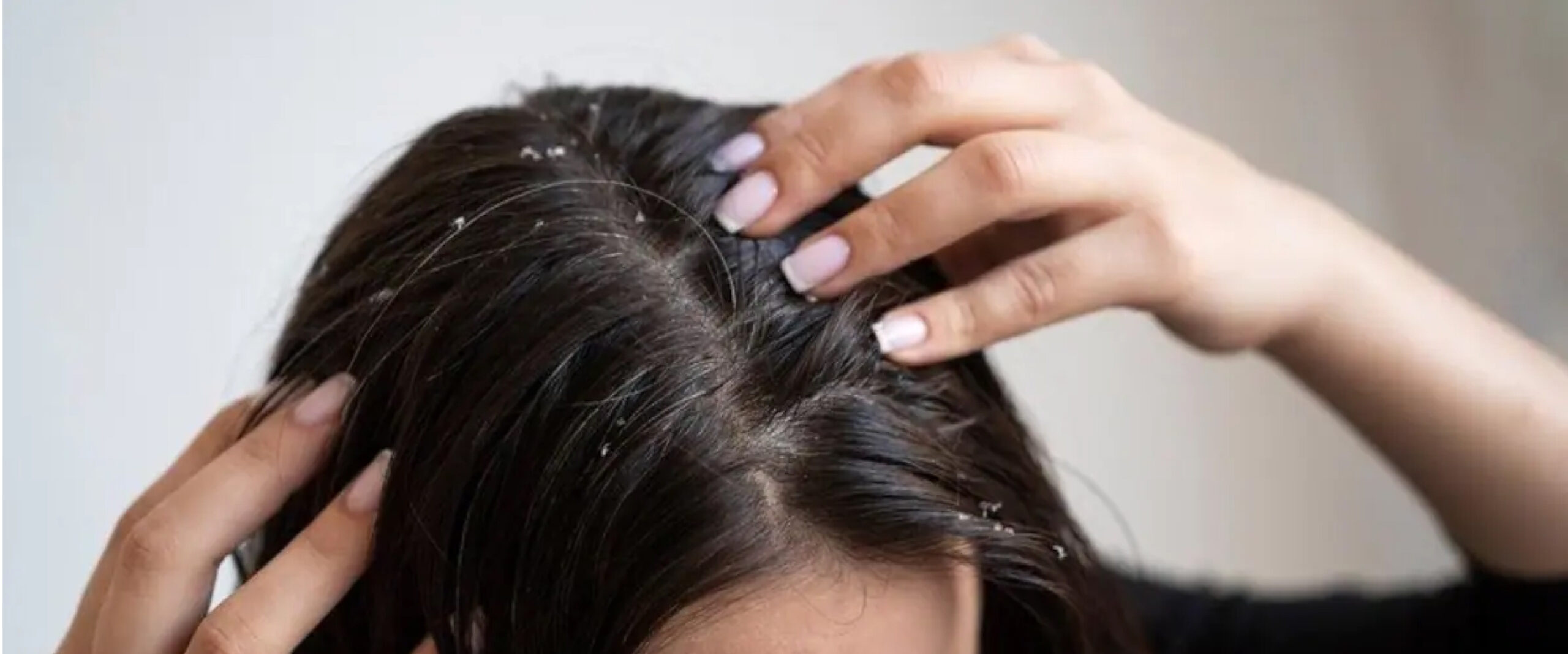 Dandruff Treatment in Mira Bhayandar - Hair Treatment Services