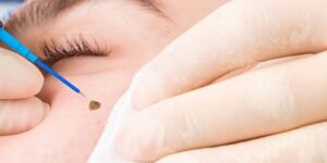 Milia/Wart/Skin Tag Removal Treatment in Mira Bhayandar