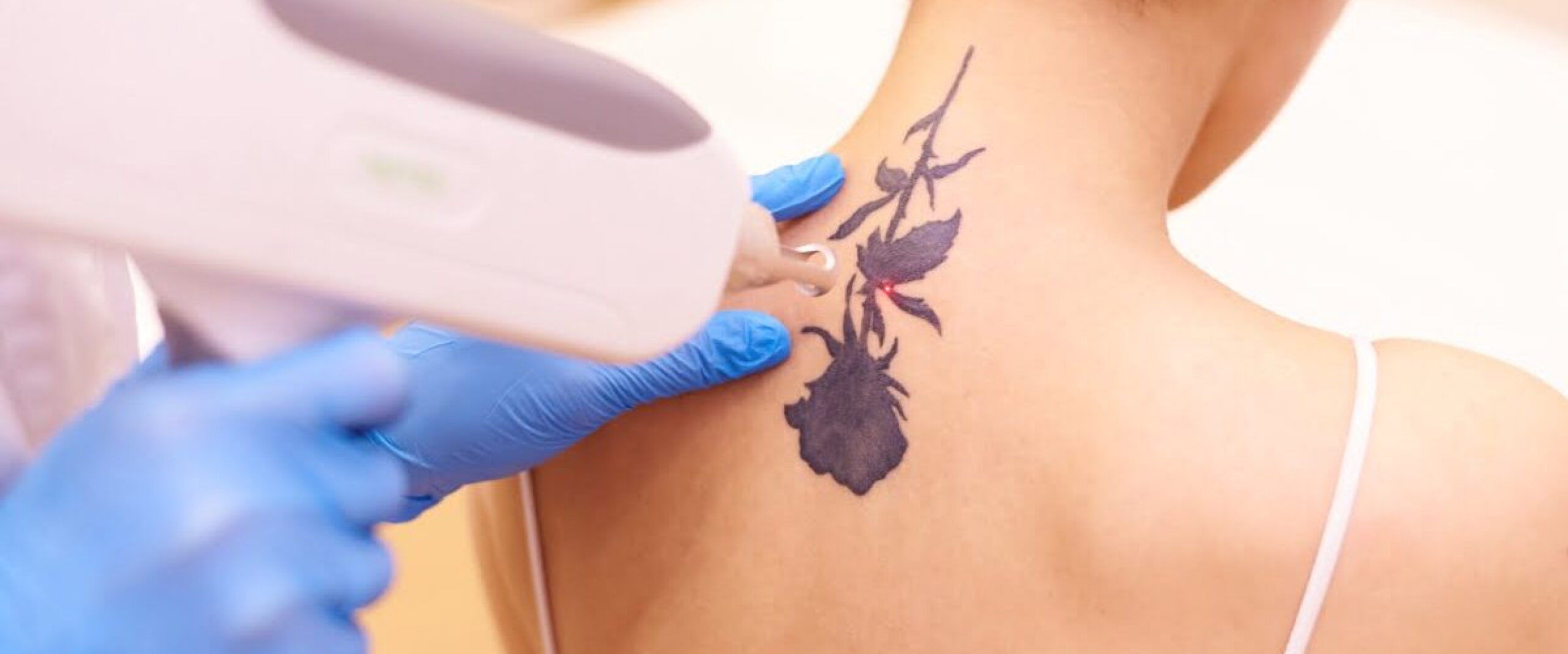 Tattoo Removal Treatment in Mira Bhayandar