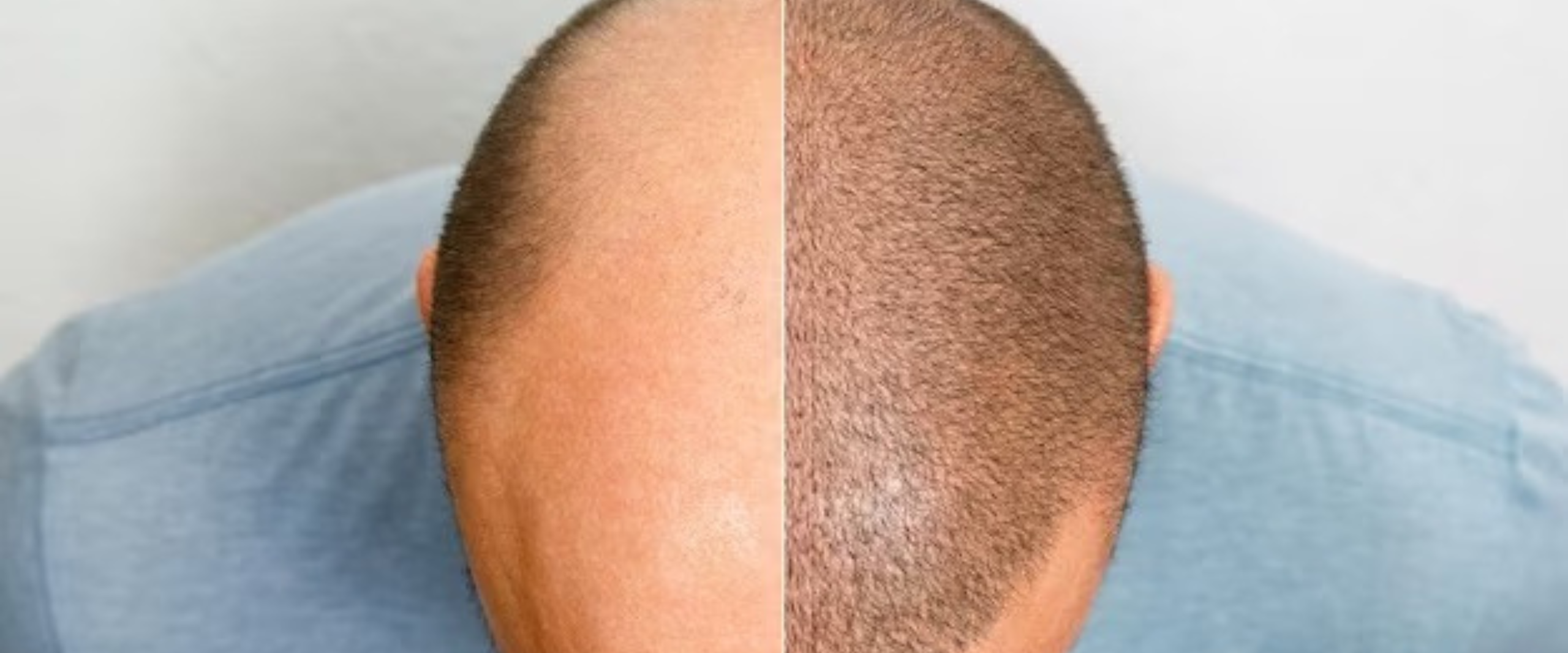 Hair Transplant Treatment in Mira Bhayandar