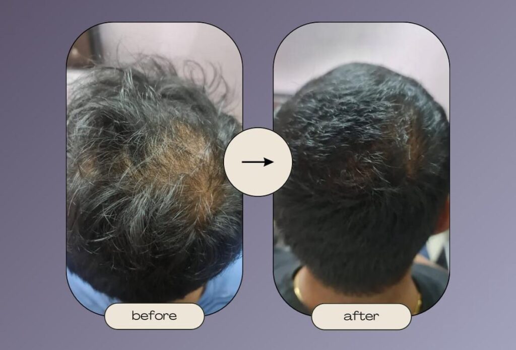 Hair loss Treatment - Before After