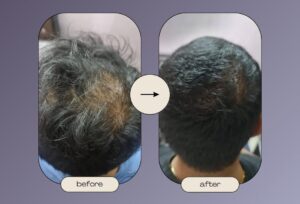 Hair Mesotherapy - Before After