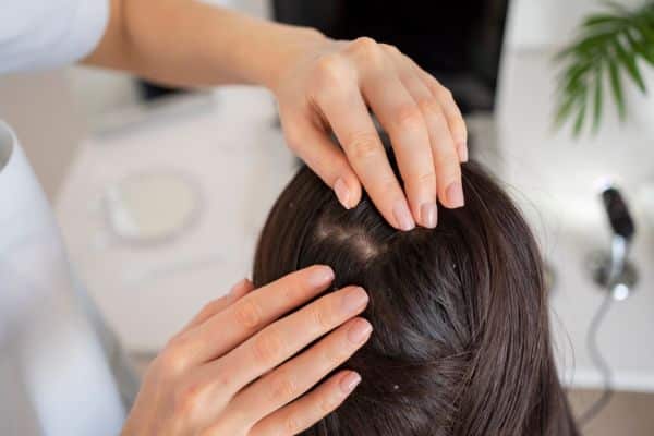 What is Dandruff Treatment