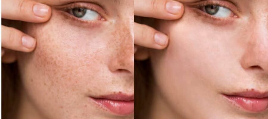 Freckle Removal Treatment - Manas Aesthetic