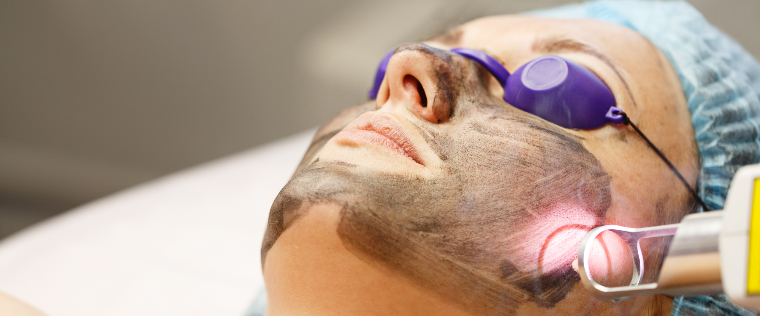 Carbon Laser Peel