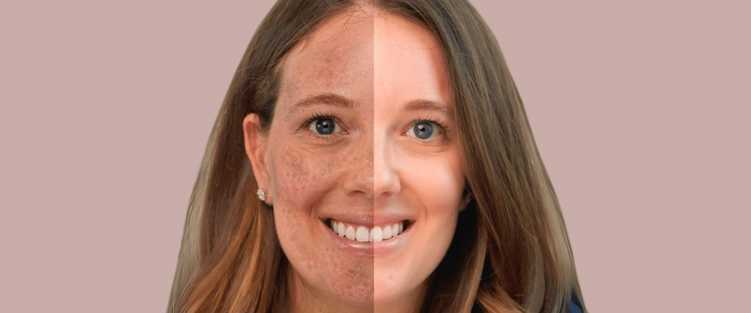 Melasma Removal Treatment