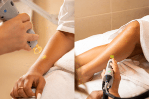 Tan Removal 